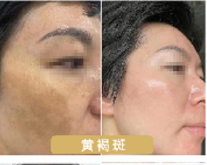 素颜黄褐斑肌肤_养_护_修-素延